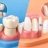Crown Versus Veneer: Which Treatment Suits You?
