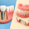 Implant Versus Denture: Which Feels More Natural?