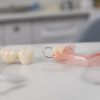 dental bridge vs partial denture for one missing tooth 1792558386
