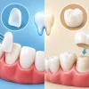 Veneers Versus Crowns: Which Is Right for You?